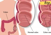 მსხვილი ნაწლავის კიბოს 10 მაფრთხილებელი ნიშანი! ეს აუცილებლად უნდა გაითვალისწინოთ