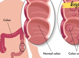 მსხვილი ნაწლავის კიბოს 10 მაფრთხილებელი ნიშანი! ეს აუცილებლად უნდა გაითვალისწინოთ