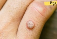 საოჯახო საშუალებები მეჭეჭის წინააღმდეგ