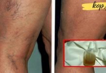 მოშორეთ კაპილარების პრობლემა, დაუბრუნეთ კანს სილამაზე საოცარი ბალზამით-ეფექტურია!