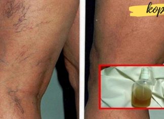 მოშორეთ კაპილარების პრობლემა, დაუბრუნეთ კანს სილამაზე საოცარი ბალზამით-ეფექტურია!