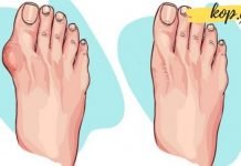 სამკურნალო მცენარეები, რომლებიც ხელს უწყობენ ბურსიტის წინააღმდეგ ბრძოლას