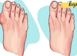 სამკურნალო მცენარეები, რომლებიც ხელს უწყობენ ბურსიტის წინააღმდეგ ბრძოლას