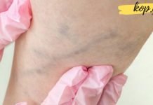 ვარიკოზული ვენების ხალხური მალამო, რომელმაც დედაჩემი ოპერაციას გადაარჩინა. შედეგით გაოცდებით!