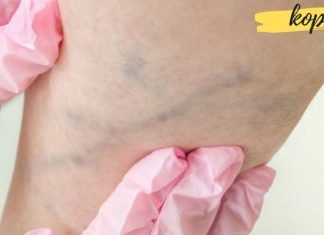 ვარიკოზული ვენების ხალხური მალამო, რომელმაც დედაჩემი ოპერაციას გადაარჩინა. შედეგით გაოცდებით!