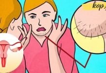 ნიკაპზე თმის ამოსვლის მიზეზები და მათი აღმოფხვრის ეფექტუეი გზები