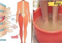 საჯდომი ნერვის მკურნალობა სახლის პირობებში