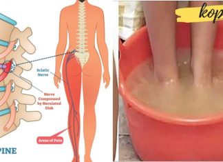 საჯდომი ნერვის მკურნალობა სახლის პირობებში