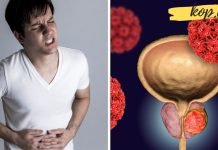 როგორ შეიძება ვიმკურნალოთ პროსტატაზე? ეს ბევრს დაეხმარა