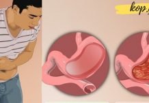 თუ გასტრიტის აუტანელი ტკივილები გაწუხებთ, მაშინ ეს საშუალებები უნდა გამოიყენოთ