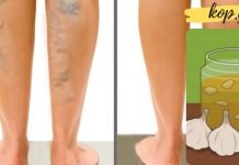 ნიორი ხელს უშლის ვარიკოზული ვენების წარმოქმნას. რეცეპტი იხილეთ სტატიაში!