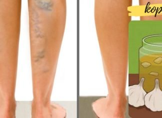 ნიორი ხელს უშლის ვარიკოზული ვენების წარმოქმნას. რეცეპტი იხილეთ სტატიაში!