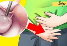 ეს საშუალებები დაგეხმარებათ საკვერცხის კისტის მოცილებაში