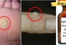 მეჭეჭების და პაპილომების მოცილება წყალბადის ზეჟანგით! ეს ძალიან დაგეხმარებათ