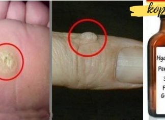 მეჭეჭების და პაპილომების მოცილება წყალბადის ზეჟანგით! ეს ძალიან დაგეხმარებათ