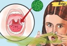 ამ ნაყენის პირში ერთხელ გამოვლებით ცუდ სუნს 1 წლით დაემშვიდობებით! – მარტივი რეცეპტი