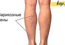 როგორ დავამარცხოთ ვარიკოზული ვენების პრობლება?! ამაში ეს ნატურალური საშულებები დაგეხმარებათ