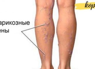 როგორ დავამარცხოთ ვარიკოზული ვენების პრობლება?! ამაში ეს ნატურალური საშულებები დაგეხმარებათ