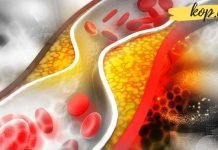 გაიწმინდეთ სისხლძარღვები კამით ვალერიანითა და თაფლით. ყველაზე ეფექტური მეთოდია რაც კი მიცდია