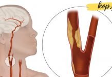ეს საშუალებები დაგეხმარებათ სისხლძარღვების გაწმენდაში