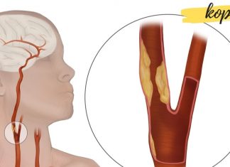 ეს საშუალებები დაგეხმარებათ სისხლძარღვების გაწმენდაში