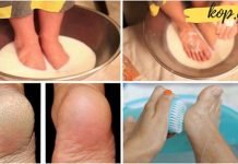 ამ მეთოდის გამოყენების შემდეგ თქვენ დაივიწყებთ დამსკდარი ქუსლების არსებობას! ეს უნდა სცადოთ..