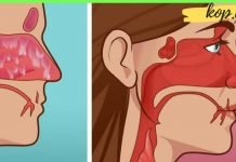 ჰაიმორიტის სამკურნალო მალამო – რა საშუალებები არაღ ვცადე – მხოლოდ ეს მალამო დამეხმარა!