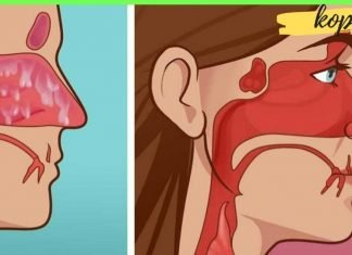 ჰაიმორიტის სამკურნალო მალამო – რა საშუალებები არაღ ვცადე – მხოლოდ ეს მალამო დამეხმარა!