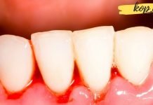 თუ კბილებიდან სისხლდენა გაწუხებთ, მაშინ გამოიყენეთ ეს საშუალებები მათ შესაჩერებლად