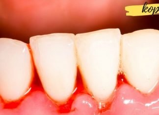 თუ კბილებიდან სისხლდენა გაწუხებთ, მაშინ გამოიყენეთ ეს საშუალებები მათ შესაჩერებლად