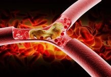 როგორ გამოვავლინოთ გვაქვს თუ არა მაღალი ქოლესტერინის შემცველობა სისხლში?