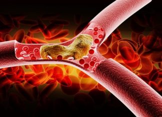 როგორ გამოვავლინოთ გვაქვს თუ არა მაღალი ქოლესტერინის შემცველობა სისხლში?