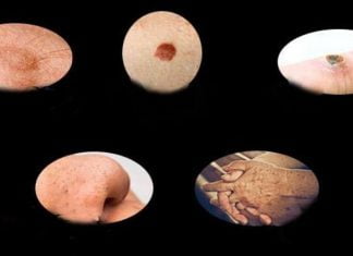 კანის პრობლემების გადაჭრის მარტივი და ბუნებრივი გზები. სასარგებლო ინფორმაციაა