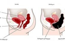 როგორ მოვიშოროთ მუცელი და დავივიწყოთ მუდმივი დისკომფორტის შესახებ? 5 სასარგებლო რჩევა