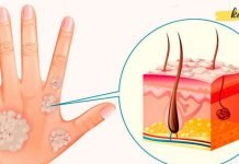 ფსორიაზის მკურნალობის 5 ბუნებრივი საშუალება