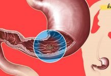 როგორ უნდა გაიგოთ, გაქვთ თუ არა კუჭის წყლული? ამის ცოდნა დაგეხმარებათ პრობლემის დროულად აღმოფხვრაში