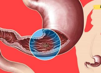 როგორ უნდა გაიგოთ, გაქვთ თუ არა კუჭის წყლული? ამის ცოდნა დაგეხმარებათ პრობლემის დროულად აღმოფხვრაში