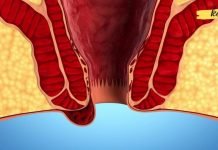 ბუასილის პროფილაქტიკა და მკურნალობა ბუნებრივი საშუალებებით