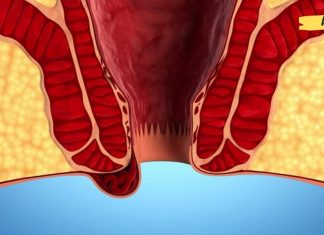 ბუასილის პროფილაქტიკა და მკურნალობა ბუნებრივი საშუალებებით