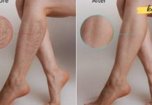 ვარიკოზული ვენების ალტერნატიული მკურნალობა! იაფი და ეფექტური მეთოდები ..