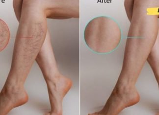 ვარიკოზული ვენების ალტერნატიული მკურნალობა! იაფი და ეფექტური მეთოდები ..