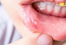 სტომატიტი: ხალხური მეთოდი, რომელიც პრობლემის მოგვარებას რამდენიმე წუთში დაეხმარება