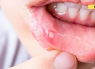 სტომატიტი: ხალხური მეთოდი, რომელიც პრობლემის მოგვარებას რამდენიმე წუთში დაეხმარება