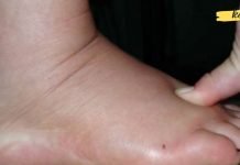 დაემშვიდობეთ სითხის შეკავებას, შეშუპებას და ჭარბ წონას მხოლოდ ერთ კვირაში ამ საოცარი რეცეპტით!