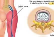 საჯდომის ნერვის მკურნალობა ხალხური საშუალებებით