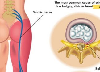 საჯდომის ნერვის მკურნალობა ხალხური საშუალებებით