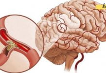 მაღალი წნევა და ტკივილი თავის არეში: როგორ აღვადგინოთ სისხლძარღვების ელასტიურობა წამლების გარეშე!!