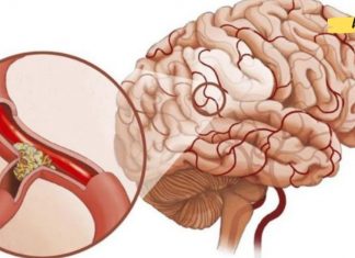 მაღალი წნევა და ტკივილი თავის არეში: როგორ აღვადგინოთ სისხლძარღვების ელასტიურობა წამლების გარეშე!!