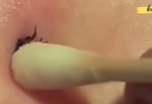 როგორ ამოიღოთ ტკიპა კანიდან სახლის პირობებში: მეთოდი, რომელმაც გადაარჩინა ასობით ადამიანი!