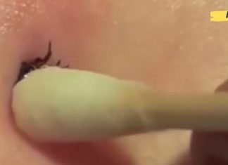 როგორ ამოიღოთ ტკიპა კანიდან სახლის პირობებში: მეთოდი, რომელმაც გადაარჩინა ასობით ადამიანი!